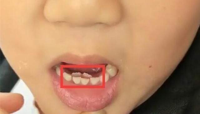 不已|6岁男孩长出“双排牙”,要一颗颗拔掉,妈妈自责不已,都怪我