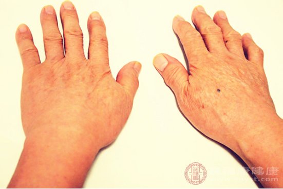 手背出現老人斑怎么辦
