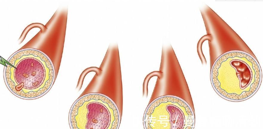 疏通|动脉硬化有2大“杀手”，教你3招快速疏通，血管通了，脑梗不来