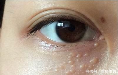 水杨酸|闭口、黑头、痘痘、脂肪粒……终于分清它们是什么了