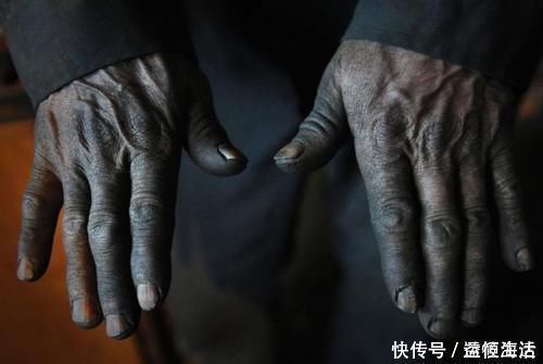 饮食习惯|治好的癌症为何又复发了,或许与5点有关,早了解早预防