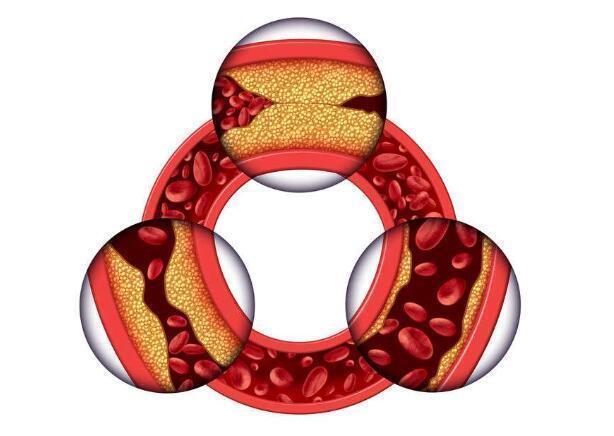 烹调油|冠心病患者,要戒口!这3类食物要“远离”,否则会加重病情