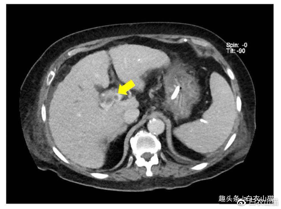病人|注意，如有人出现这种皮纹，往往提示他内脏有癌！