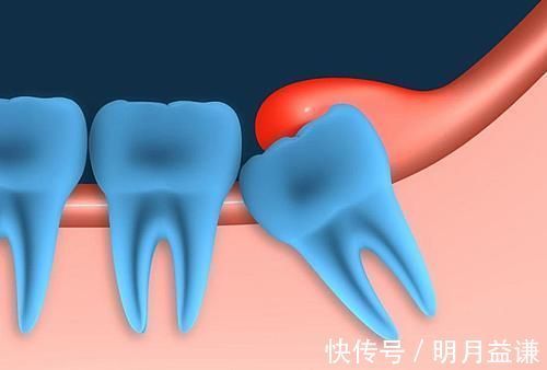 口腔疾病|哪些疾病需要在备孕的时候处理，否则怀孕后可能会后悔莫及？