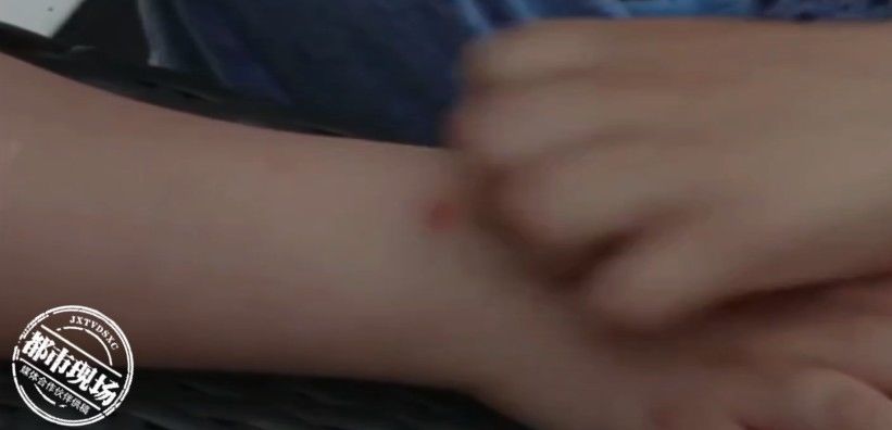 叮咬|孩子被蚊子叮咬后，千万别这么做，医生：小心加重感染
