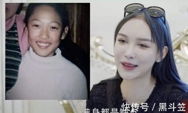 治疗 14岁时,我接受了母亲的治疗,我花了400万美元进行整形手术!