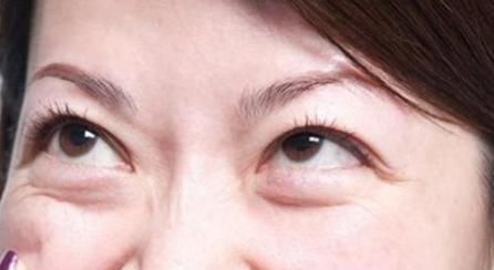 眼睛下面总是会有细小的皱纹，你应该怎么办改善？赶紧来看