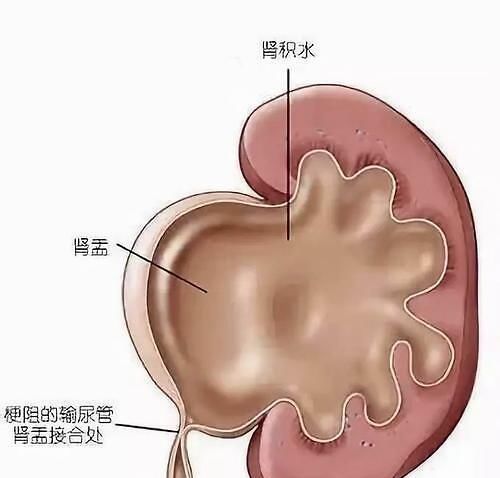 害怕|很多人害怕胆结石,那什么样的人容易得胆结石呢?