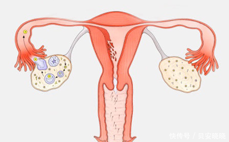 卵巢|贝安：卵泡多就一定是多囊卵巢吗？