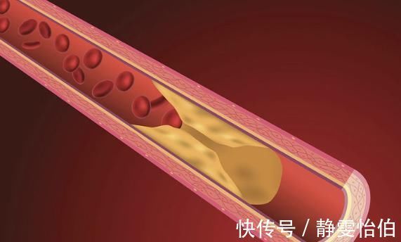 医院|脑梗塞降临前,颈部通常会发出1个信号,尽早去医院做个检查!