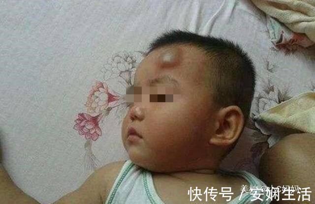 宝妈|3岁男孩被开水烫伤,宝妈的急救方法,医生称赞连连