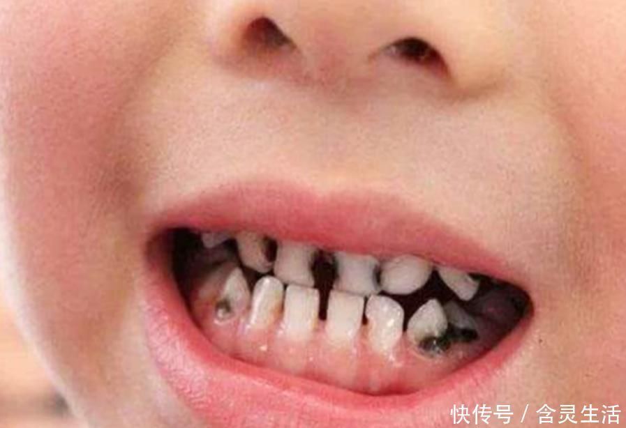 妈妈|4岁孩子一嘴黑牙，妈妈毫不在意认为牙齿能换，牙医叹气无知