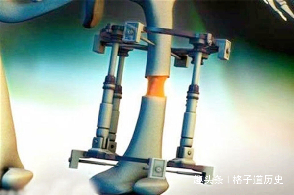 李亚诺|当年那个花费16万,断骨增高7.2厘米的男生李亚诺,如今怎样了