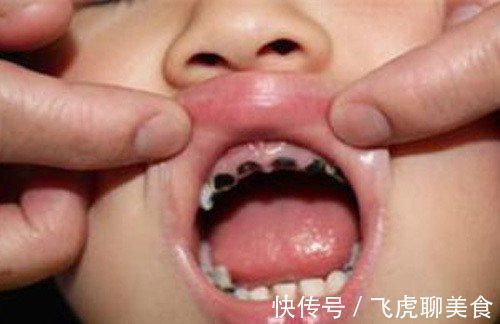 黏性|宝宝满口蛀牙？不一定是糖果惹的祸，这些常见举动更易引发龋齿