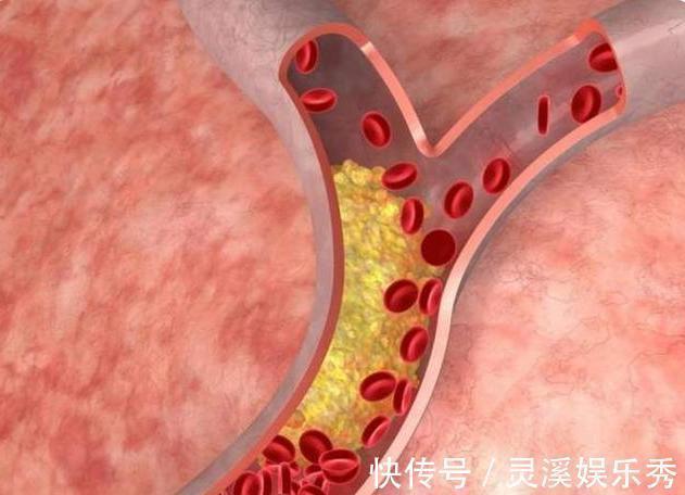 水煮肉片|比食盐还伤血管，世卫组织已呼吁停止食用，高血压患者要尽量少吃