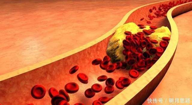 血液粘稠|高血脂的“死对头”已找到,3种水果没事多吃点,血管能一通到底