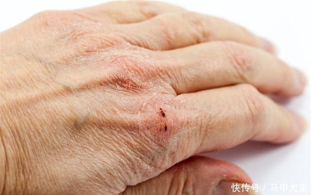 危害|痛风发作只是关节痛?严重时可威胁生命,这6大危害不可小看