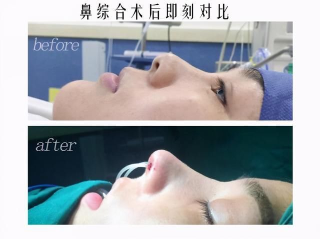 知名女星惊现“女巫鼻”天价隆鼻就能整出好鼻子