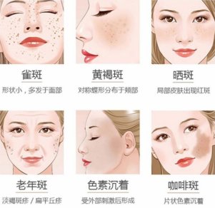 新广告法|京典丽园认为：分型有序改善才能告别色斑