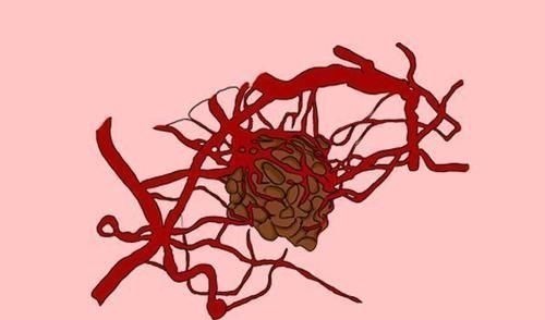 治疗|恶性肿瘤是如何进行转移的?医生列出了4个途径,早了解早预防