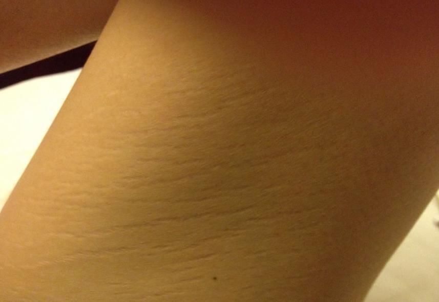 孕妇|妊娠纹是怎么产生的?网友用塑料袋像大家展示,简直不要太形象