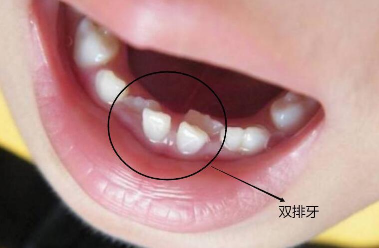 恒牙|最全儿童换牙时间表:儿童换牙何时开始、何时结束?一图说清