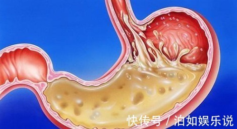 饮食|浅表性胃炎经常不舒服,医生说不用吃药,养胃做好5点很关键