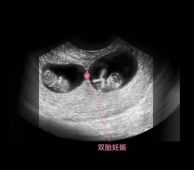 性别|胎儿从卵泡到性别形成,17张图片清晰诠释,男宝女宝看得很清楚