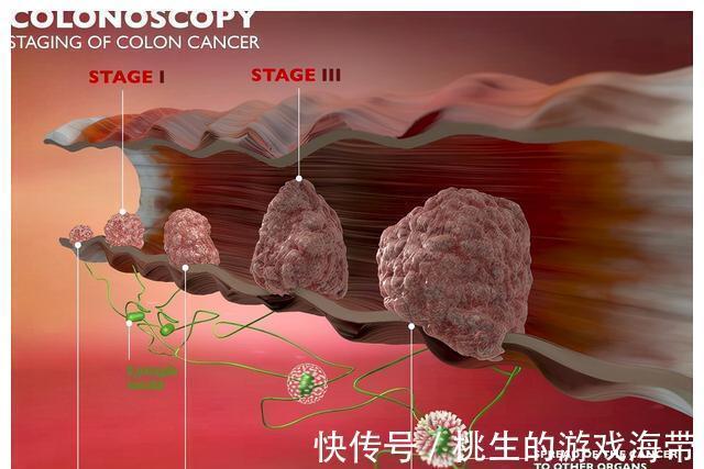 常见病|什么病会转为癌症？医生列举出了4种常见病