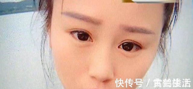 鼻峰|美女为漂亮整容,一年后鼻子歪了,眼睛也成了三角眼!商家碰瓷!