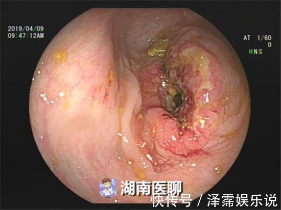 隐血试验|男子便中带血以为是痔疮所致,结果却是癌!