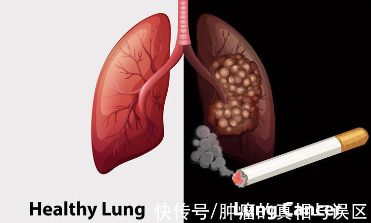 吸烟者|“很少吸烟，为何也会得肺癌？”医生抗癌十年去世，留下一个反思