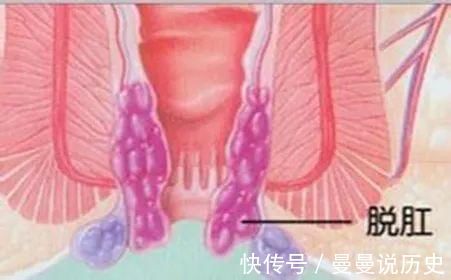 便秘|产后,十个妈妈九个“痔”?没想到最有效的“防痔”方法竟是这五招…