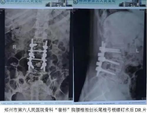 郑州一医生举报两名科主任：私自替换手术骨科螺钉，点名要收 40％ 回扣