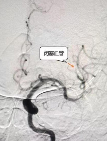 缺血性脑卒中|85岁突发急性脑梗,静脉溶栓联合血管内介入治疗挽救生命