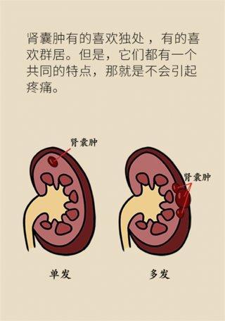 癌变|单纯性肾囊肿会癌变吗？听听专家怎么说