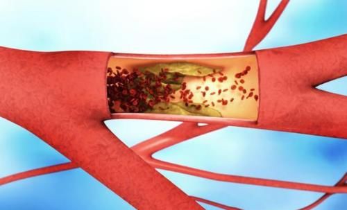 糖尿病吃杂粮主食,不吃主食容易并发症,三类