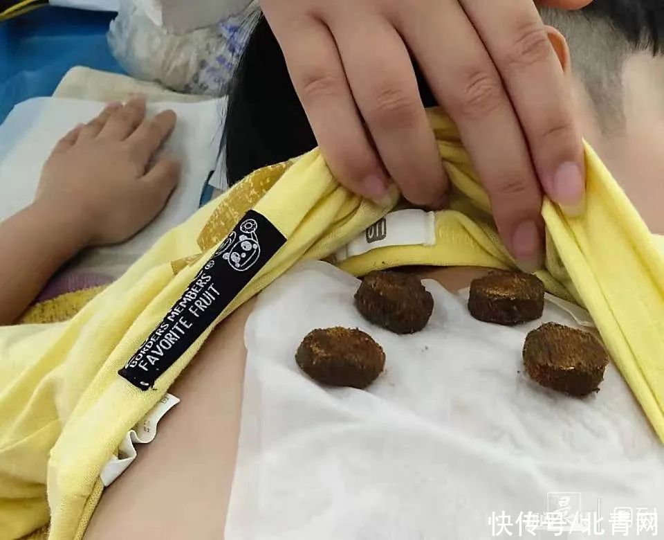 冬病夏治|三伏到，滬上醫院兒科敷貼人氣高