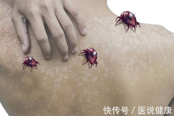 发作|荨麻疹进入晚上后,症状会加重,或与这6个因素有关,需重视