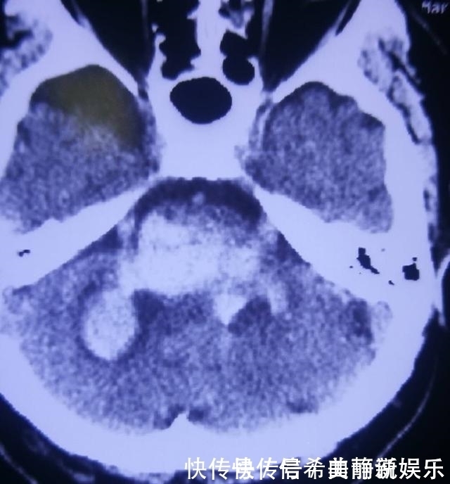 为省钱脑出血,ICU抢救积蓄花光医生痛心高血压8个误区害人啊