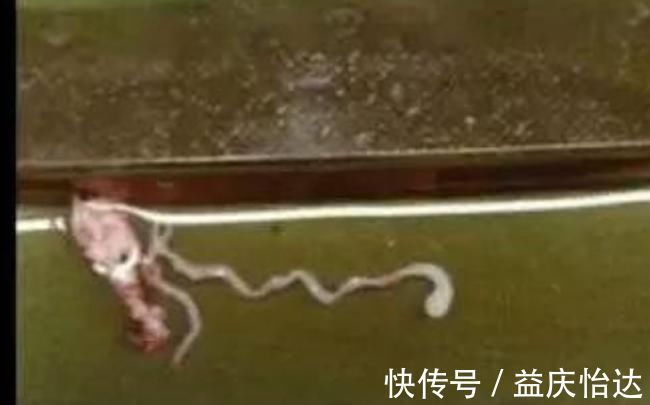 寄生虫|7岁小孩大脑取出8厘米寄生虫,医生怒骂:孩子妈怎么能如此无知