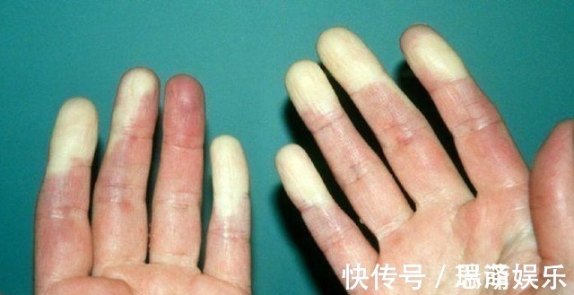 血脂|血脂高的人,多观察手指,若没这几个异常,说明脑梗离你还很远