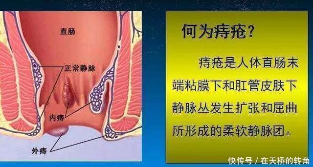 治疗|痔疮还能自愈那到底要不要治疗呢