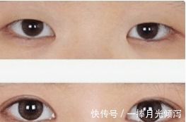 内眦赘皮 开眼角手术怎么做才能不留疤隆鼻能改善眼角吗!