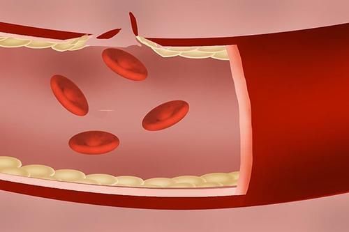 治疗|血压160110，属于几级高血压？如何降压才安全？医生分析给你听