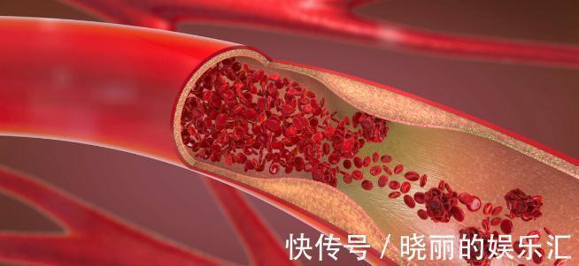 骨密度|长期吃这5种药,有骨质疏松的副作用!如果你在吃,建议尽早更换