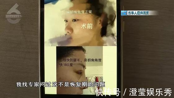 右眼|比原来丑这么多!女子花钱整成“阿凡达”眼睛都闭不上:“昨晚又是一夜没睡”