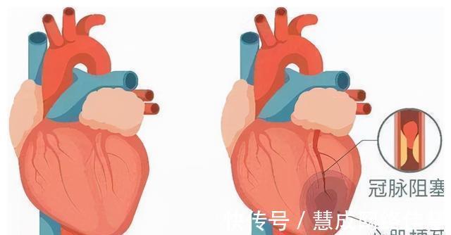 甘油三酯|不吃药,真能降血脂吗?医生确认了:能!但要认准这2种高血脂