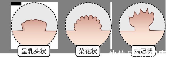 冠状沟|为什么有的男人会选择嫖娼？一次嫖娼会带来多少性病？长点记性吧