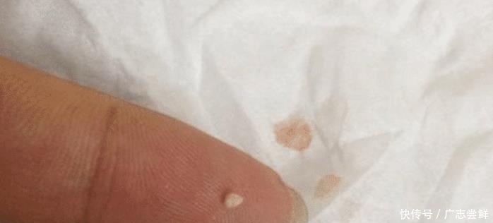 抿紧下巴后突起的“白疙瘩”,千万要注意,这是螨虫的真身吗?